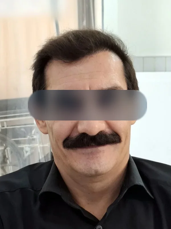 بعد از کاشت مو، مراجع کلینیک موسی‌زاده