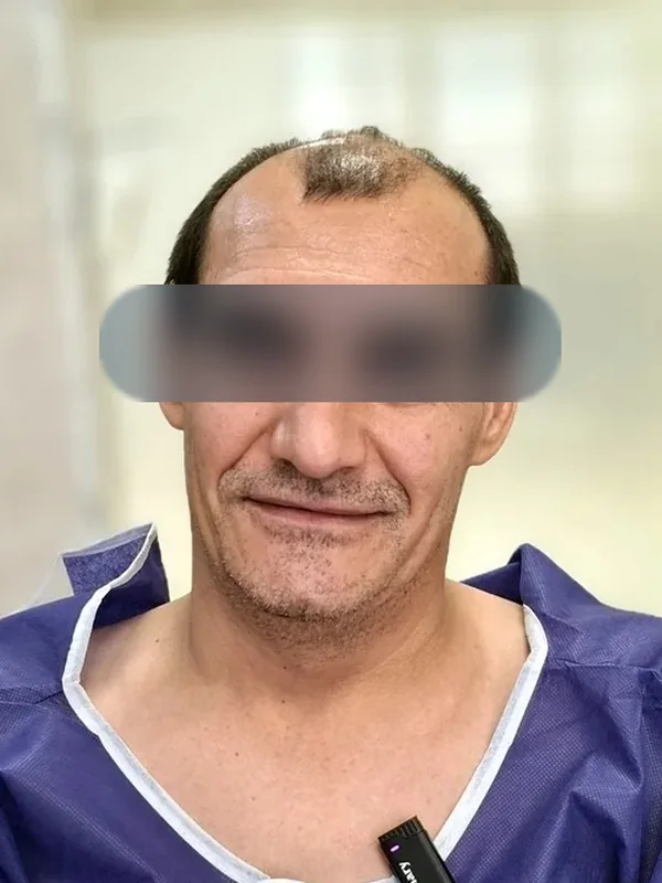 قبل از کاشت مو، مراجع کلینیک موسیزاده