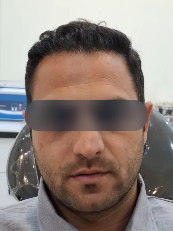 بعد از کاشت مو، مراجع کلینیک موسی‌زاده