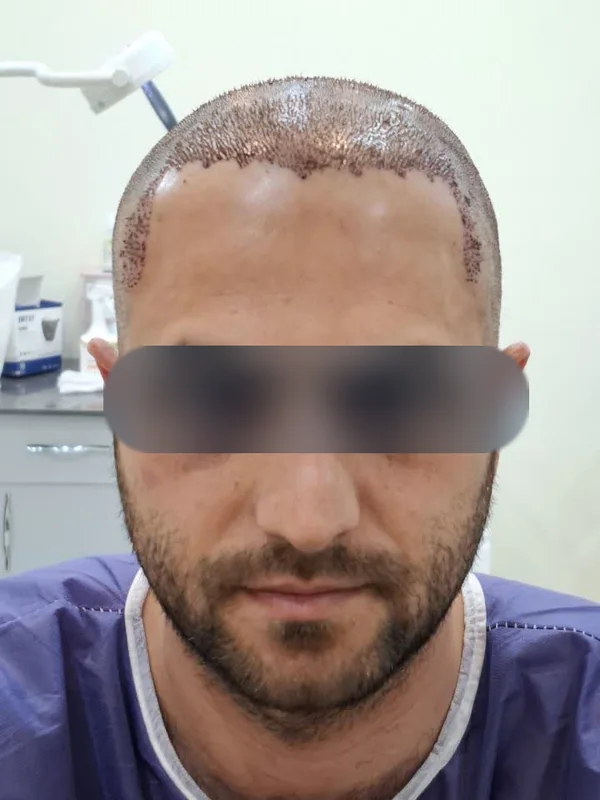 روز کاشت از کاشت مو، مراجع کلینیک موسیزاده