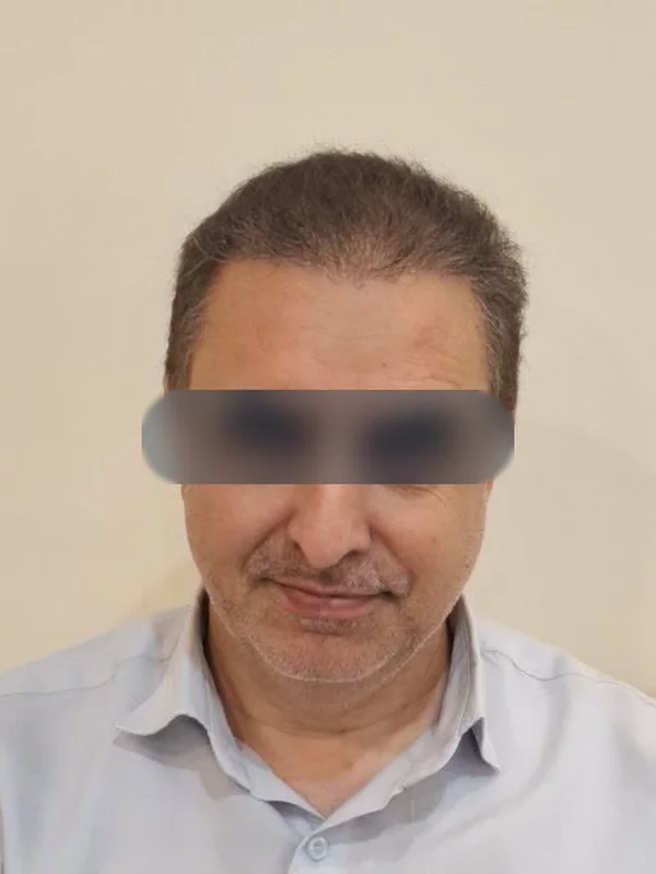بعد از کاشت مو، مراجع کلینیک موسی‌زاده
