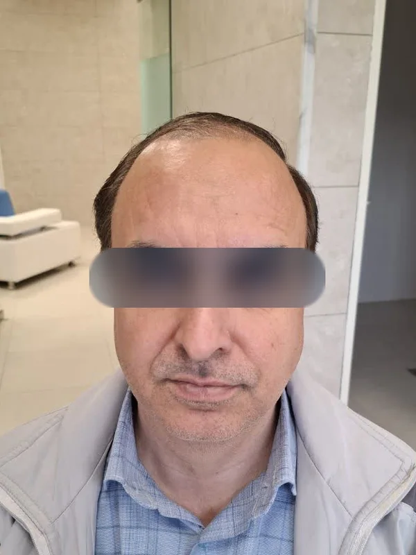 قبل از کاشت مو، مراجع کلینیک موسیزاده