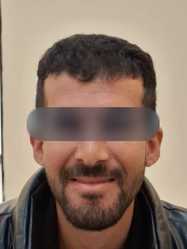 بعد از کاشت مو، مراجع کلینیک موسی‌زاده