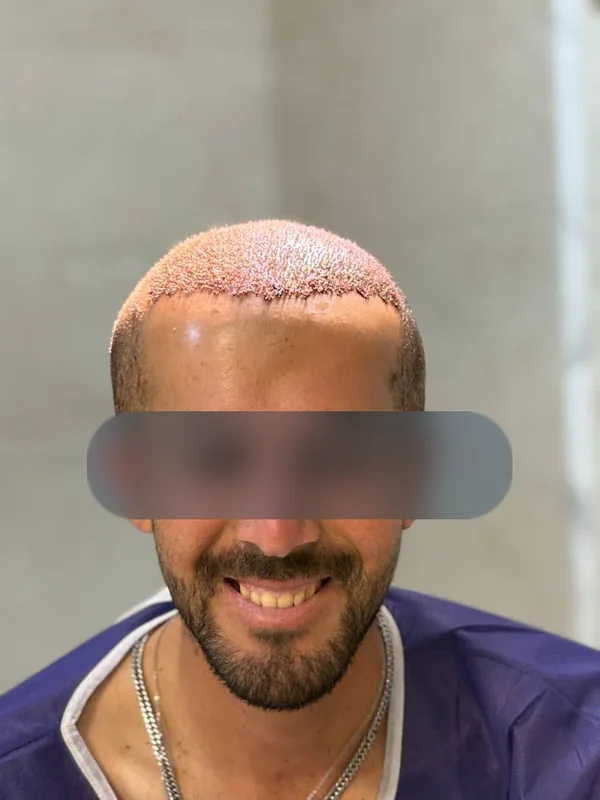 روز کاشت از کاشت مو، مراجع کلینیک موسیزاده