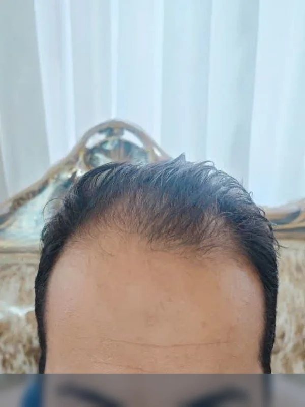 قبل از کاشت مو، مراجع کلینیک موسیزاده