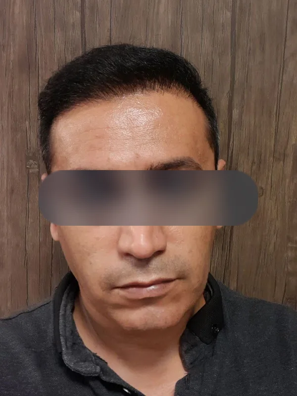 بعد از کاشت مو، مراجع کلینیک موسی‌زاده