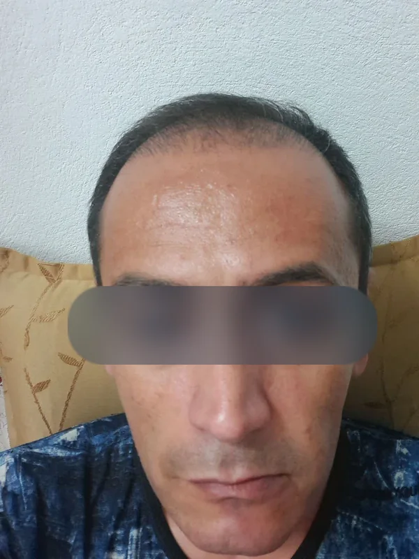 قبل از کاشت مو، مراجع کلینیک موسیزاده