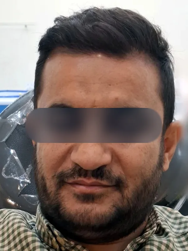 بعد از کاشت مو، مراجع کلینیک موسی‌زاده