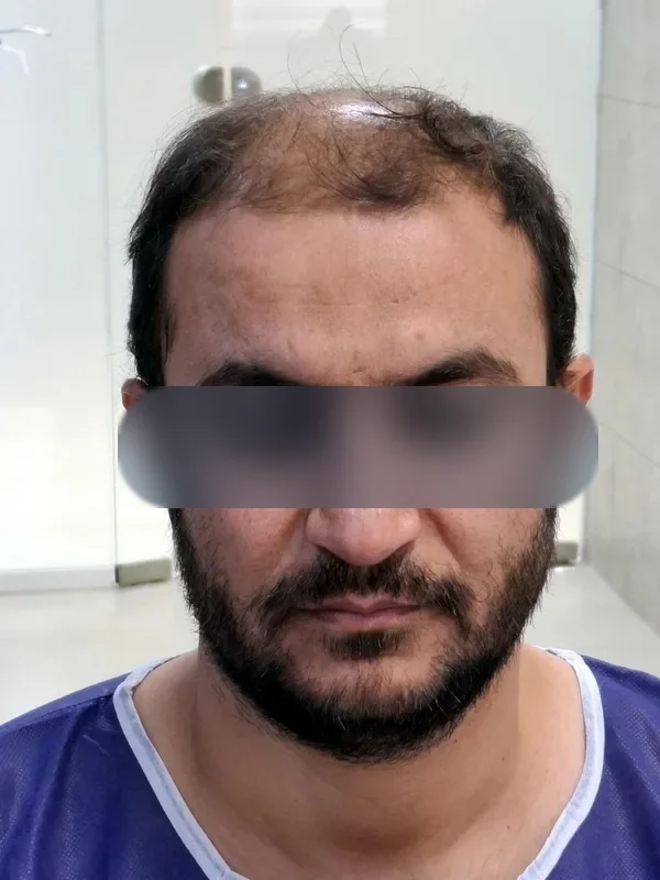 قبل از کاشت مو، مراجع کلینیک موسیزاده