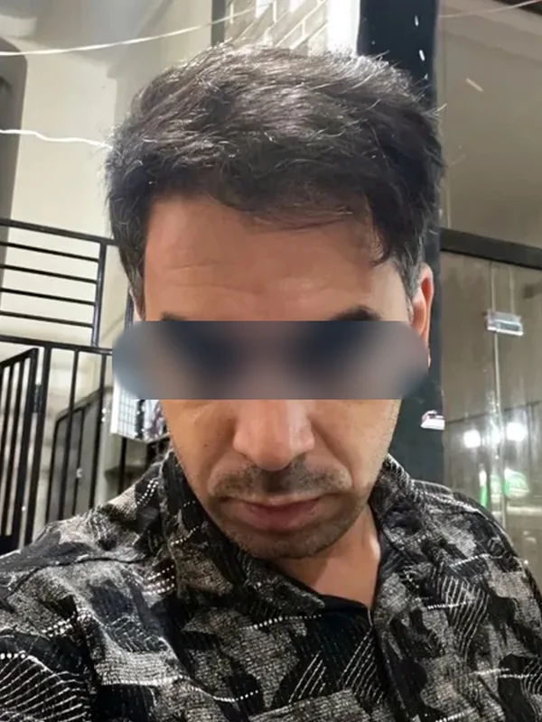 بعد از کاشت مو، مراجع کلینیک موسی‌زاده