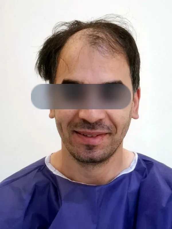 قبل از کاشت مو، مراجع کلینیک موسیزاده