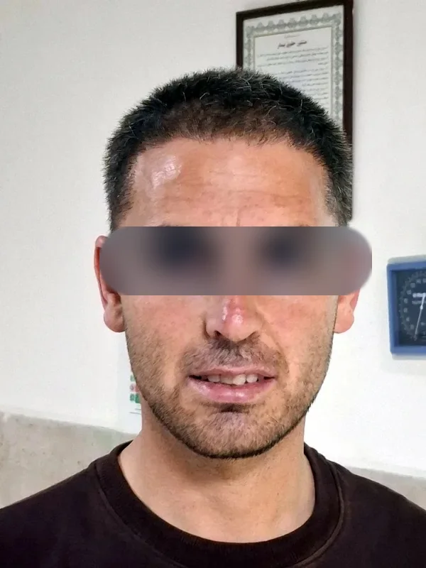 بعد از کاشت مو، مراجع کلینیک موسی‌زاده