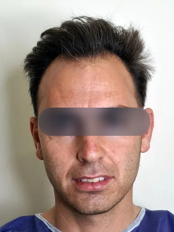 قبل از کاشت مو، مراجع کلینیک موسیزاده