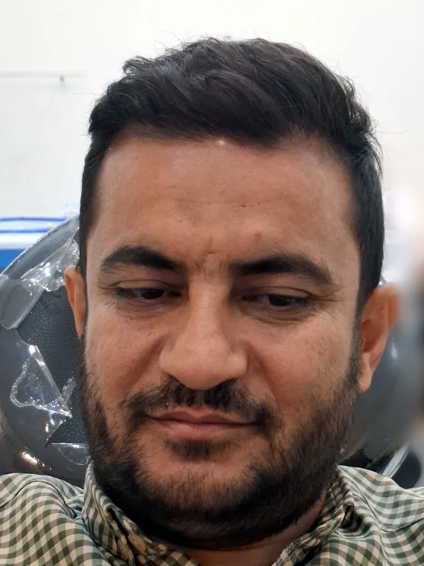 بعد از کاشت مو - نمونه ۱