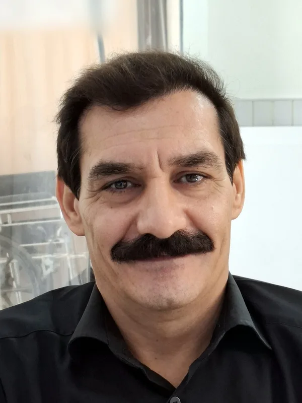 بعد از کاشت مو - نمونه ۴